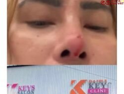 Dugaan Malapraktik Klinik Dermakeys, Korban Desak Aparat Usut Tuntas Perkara
